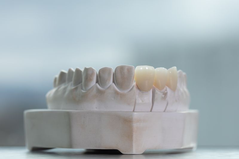 Teeth Replacement Options